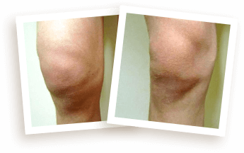 Rodilla